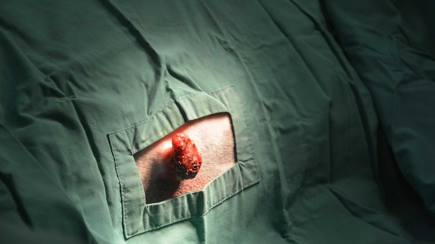 Sarcoid surgery preparation