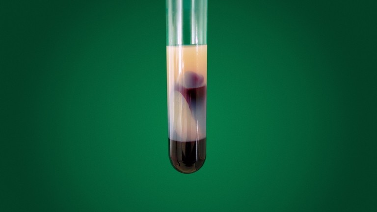 Hyperlipaemic blood sample