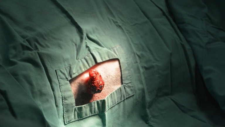 Sarcoid surgery preperation